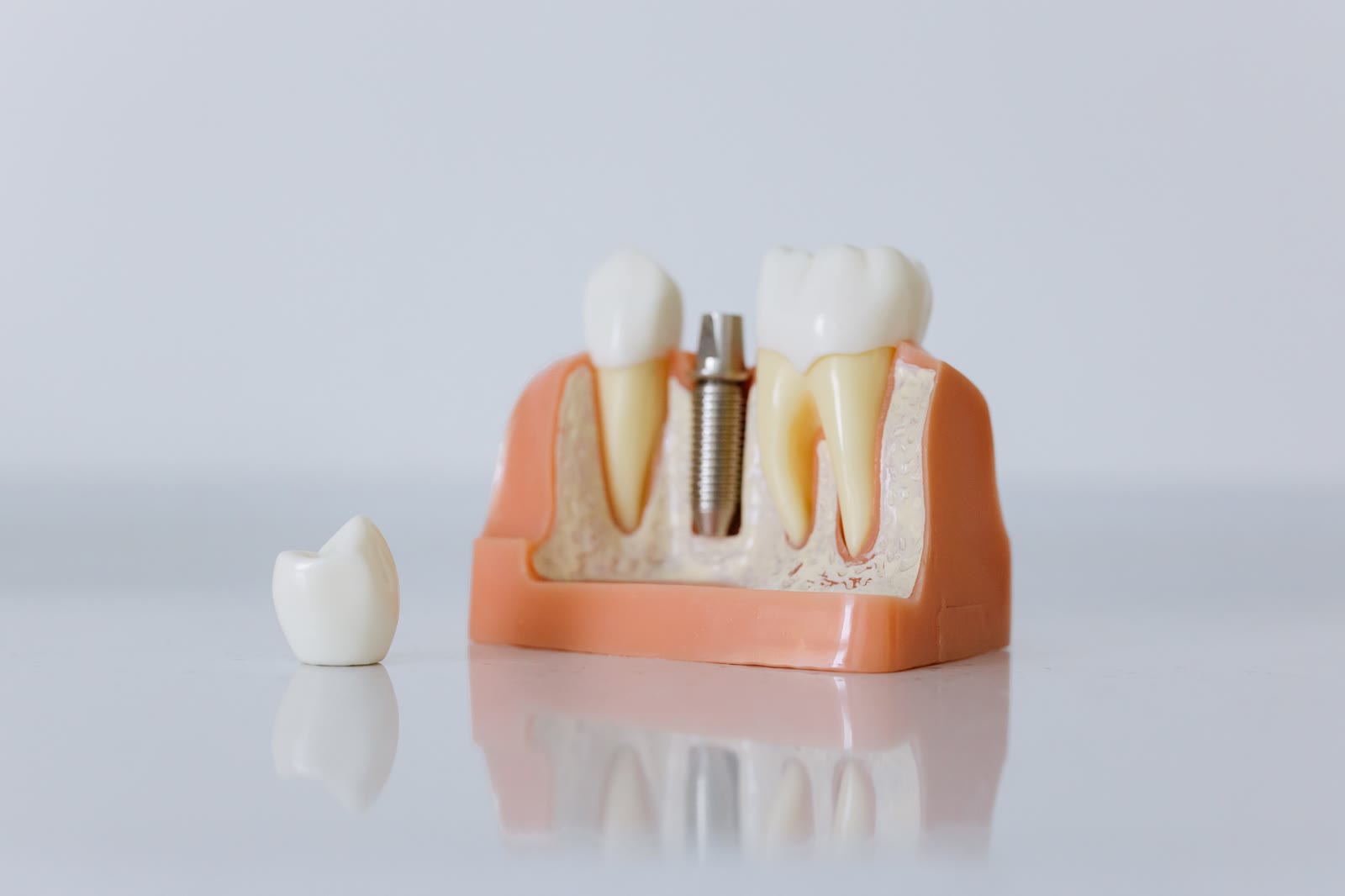 Model edukacyjny implantu zębowego z koroną